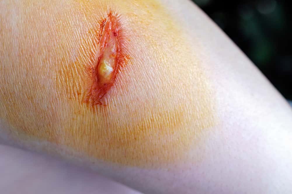 Herida en el muslo de una persona, infectada y con pus.. Se debe de lavar con médicamentos especializados para evitar infecciones.