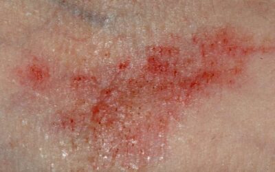 Infecciones en la piel