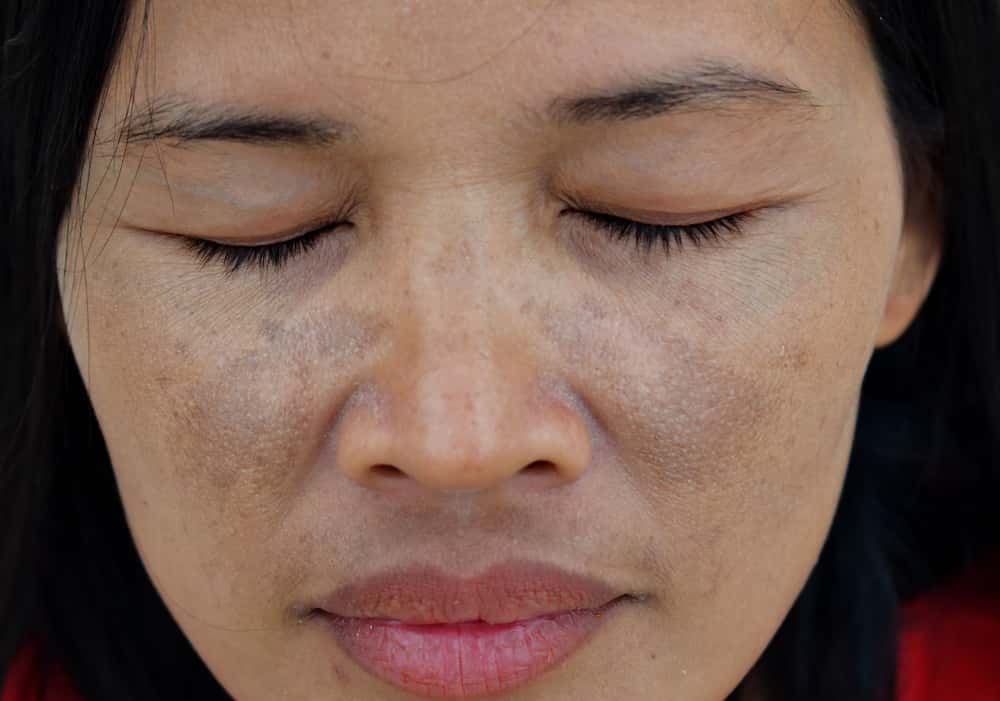 Mujer con manchas por melasma en gran parte de su rostro.