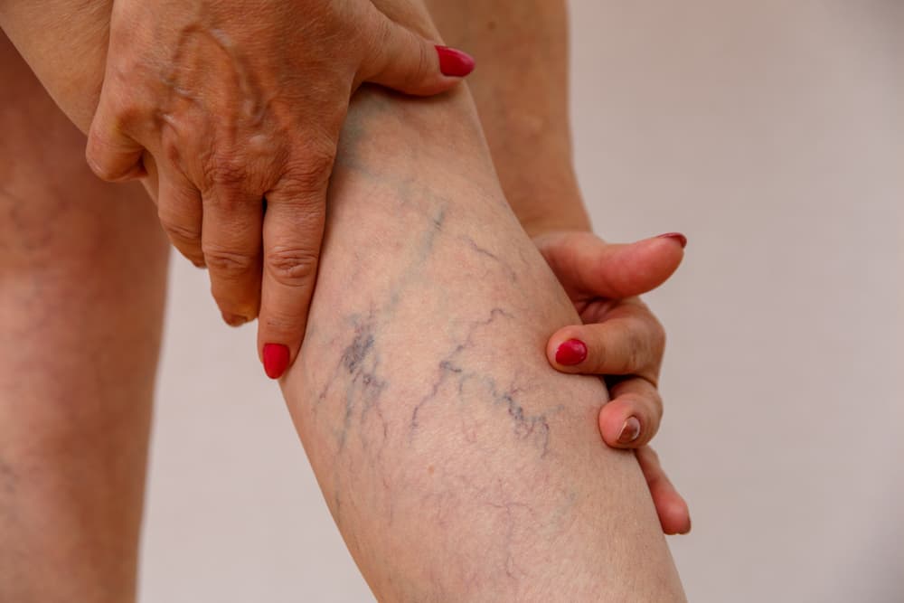 Mujer masajeando sus piernas varicosas con una crema para aliviar la pesadez y mejorar la circulación.