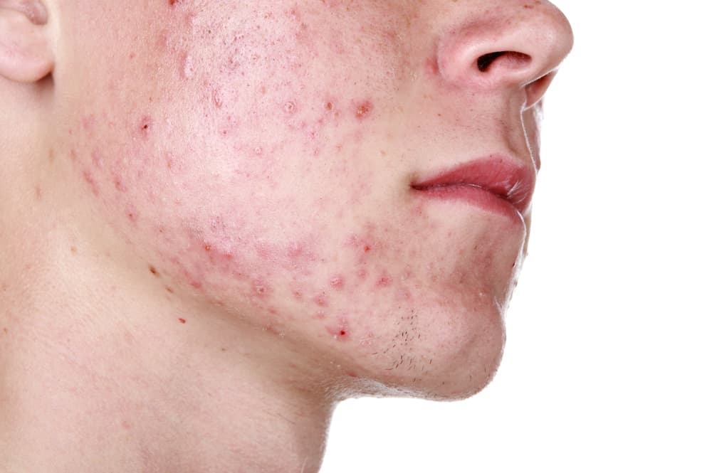Piel con mucha resequedad causada por el uso de la isotretinoína para combatir los brotes de acné severos.