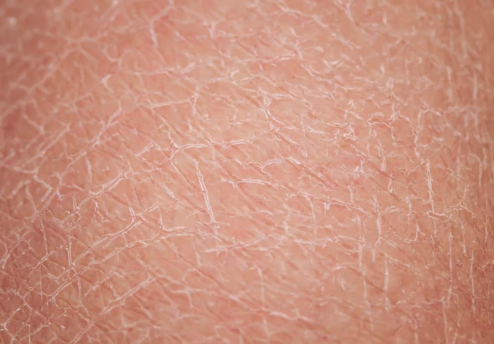 Piel con mucha resequedad causada por el uso de la isotretinoína para combatir los brotes de acné severos.