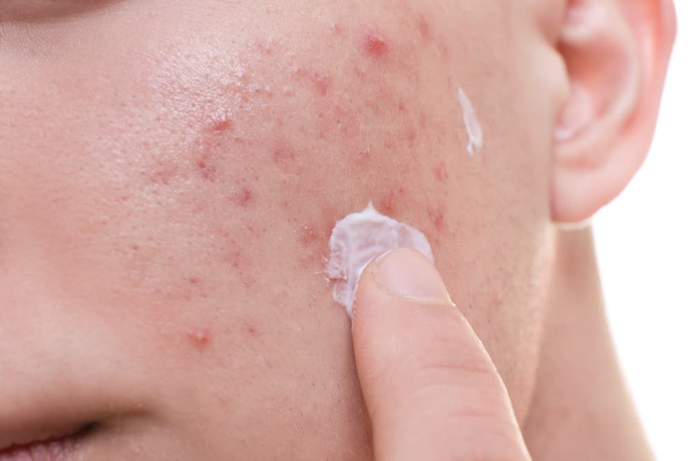 Adolescente aplicando gel para el acné que tiene en la piel de su rostro.